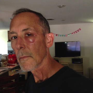 Fire ant bite near my eye. Happened not once but twice. Hate those fucking ants. Fire ant bite near my eye. Happened not once but twice. Hate those fucking ants.